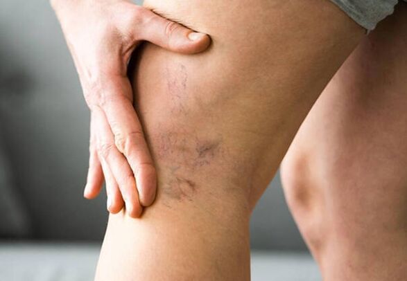 Levicose protects the legs from varicose veins