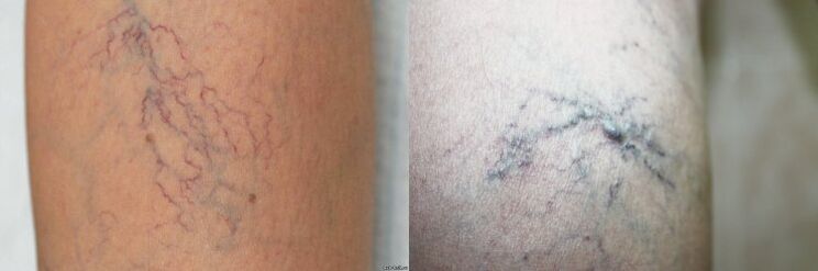 The symptoms of varicoosa