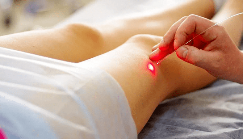 The laser coagulation of varicoosas