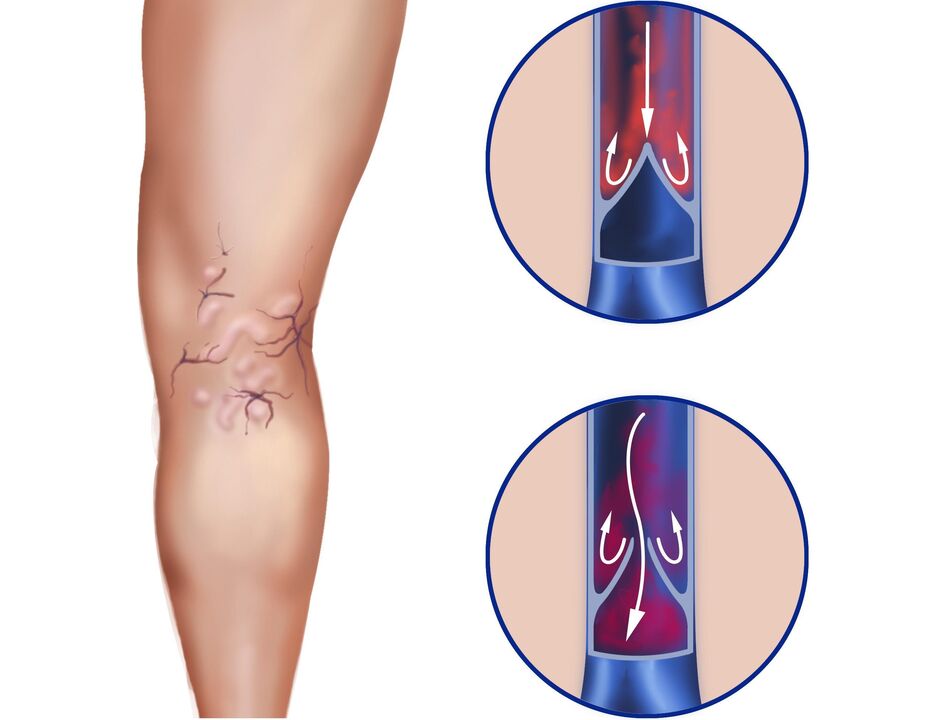 What happens to the veins of the varicos