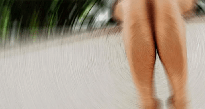 How to treat varicosus blood vessels at home