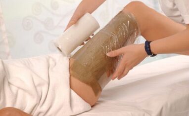 Is possible -e packaging of children for varicos
