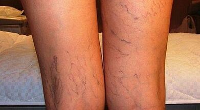How to treat varicone enlargement in women in women