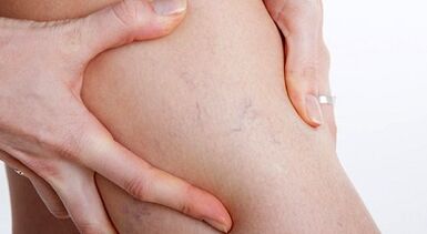 Signs and symptoms of varicoosas