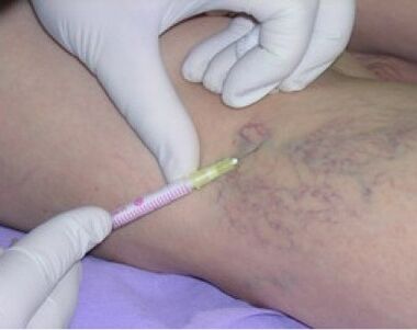 injections to varicos