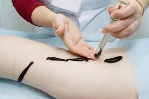 the use of leeches to treat varicose veins