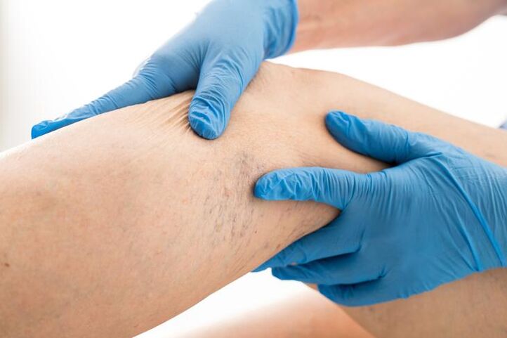 doctor examines varicose veins in the legs