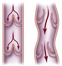 Healthy vein and impaired blood flow in varicose veins