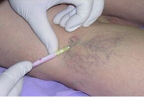 Sclerotherapy is a method for treating varicose veins of the legs