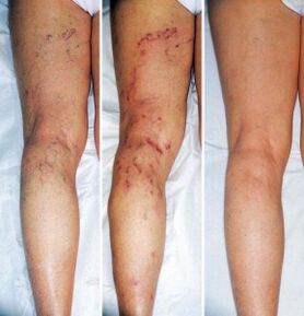 The result of the treatment of varicose veins of the lower limbs