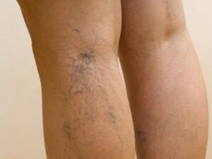 Veins protruding from under the skin are symptoms of varicose veins on the legs