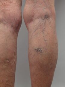 With the varicose veins of the lower limbs, the tortuous veins rise above the surface of the skin