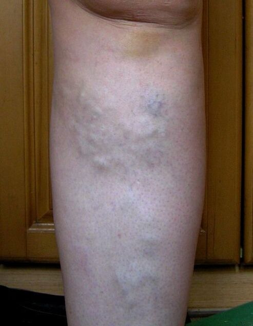 Swollen veins in the legs caused by varicose veins